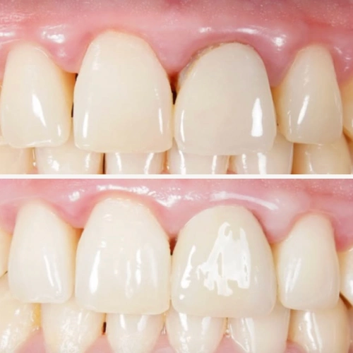 Front teeth before and after treatment