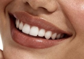 A smile after aesthetic restoration of the front teeth