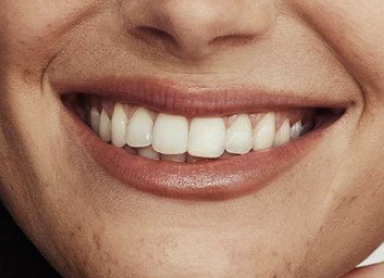 A smile after prosthetic rehabilitation