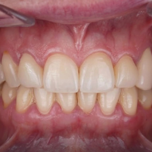 Front teeth after treatment