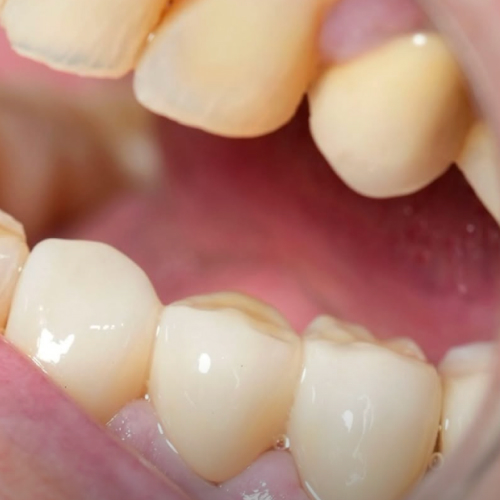 The tooth replaced after treatment
