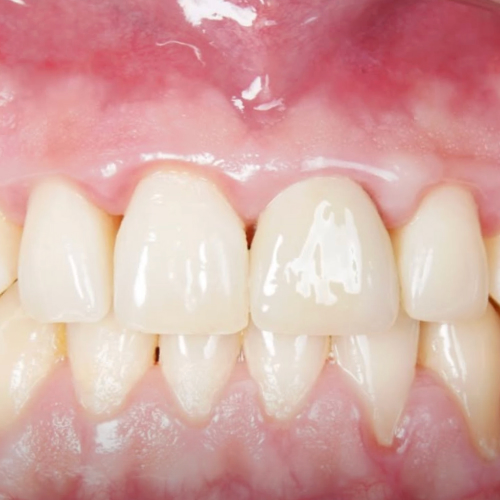Front teeth after treatment