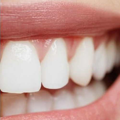 Front teeth after treatment — lighter and more even