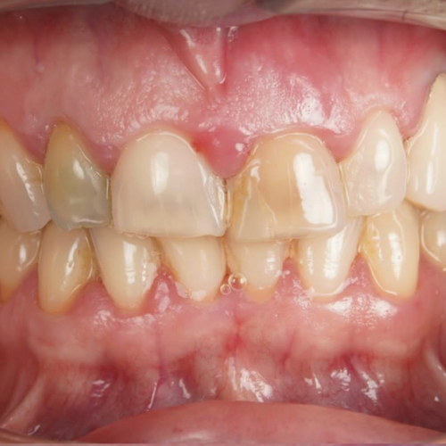 Front teeth before treatment — uneven colour and shape