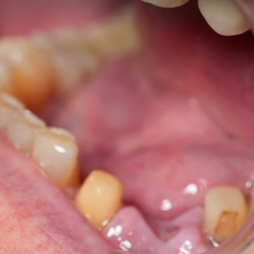 The gap from a missing tooth before treatment