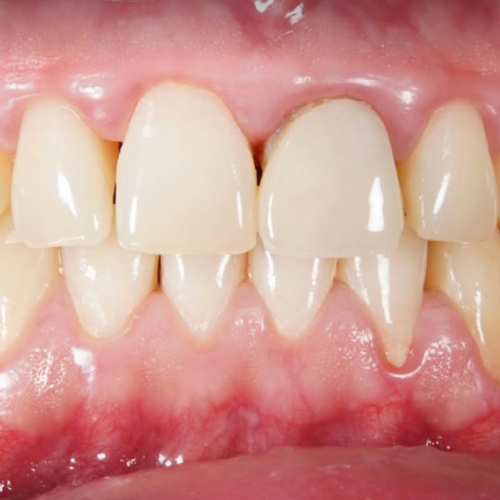 Front teeth before treatment — worn edges