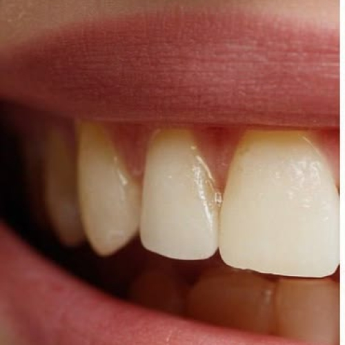 Front teeth before treatment — yellowed colour